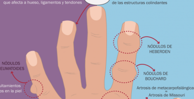 diferencias entre artritis y artrosis