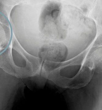 rotura de cadera en personas mayores